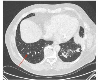Figure   4   :   TDM   pulmonaire   en   coupe   axiale   et   en   fenêtre   parenchymateuse
