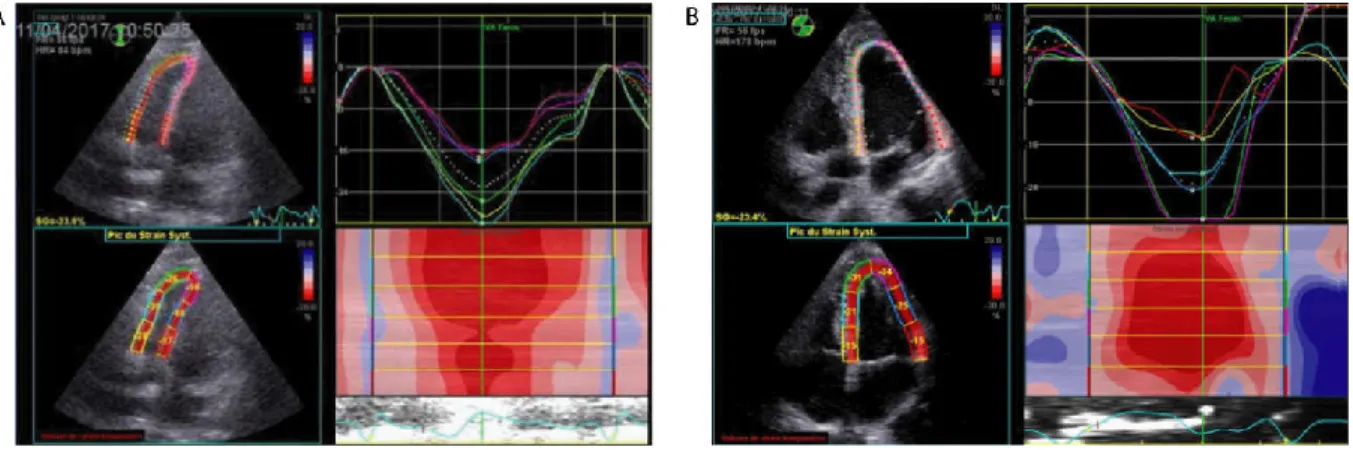 Figure 2. Exemples d'analyse de la contractilité ventriculaire gauche et droite en échographie transthoracique au repos et à  l'effort