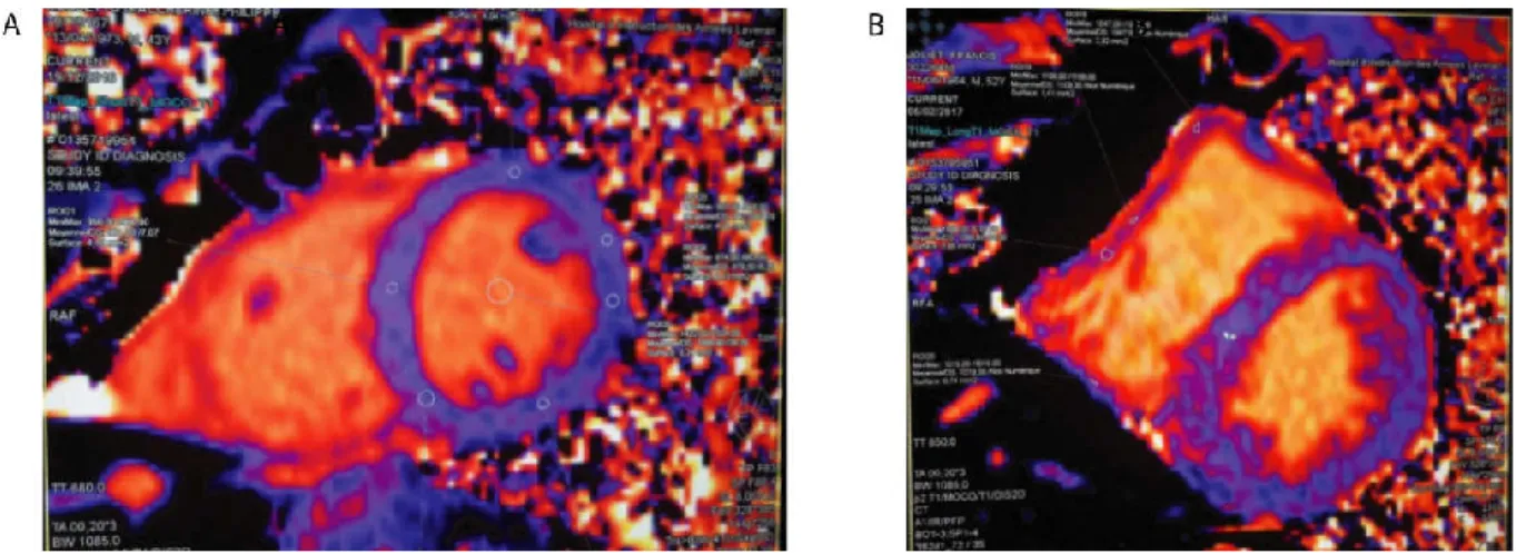 Figure  3.  Exemples  de  cartographies  paramétriques  T1  (T1  mapping  natif)  des  ventricules  gauche  et  droit  obtenues  en  imagerie cardiaque par résonance magnétique