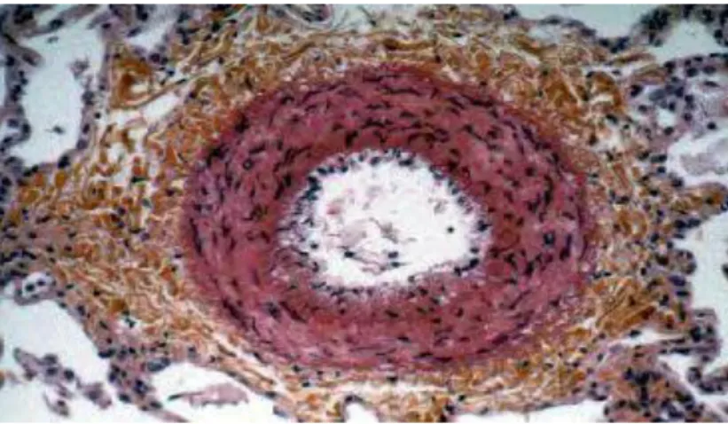 Figure 5 : coupe histologique montrant une hypertrophie de la média 