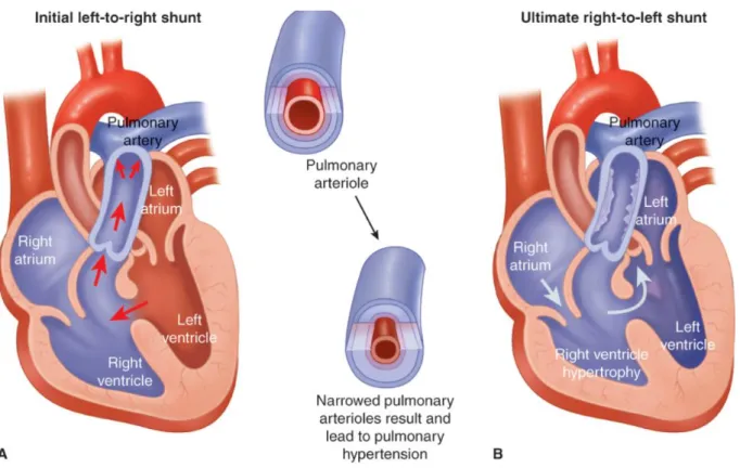 Figure 7 : représentation de l’évolution naturelle d’un syndrome d’Eisenmenger.  (A) : shunt initialement  gauche droit d’une communication inter-ventriculaire (CIV) ; (B) : inversion du shunt devant des résistances  pulmonaires trop élevées