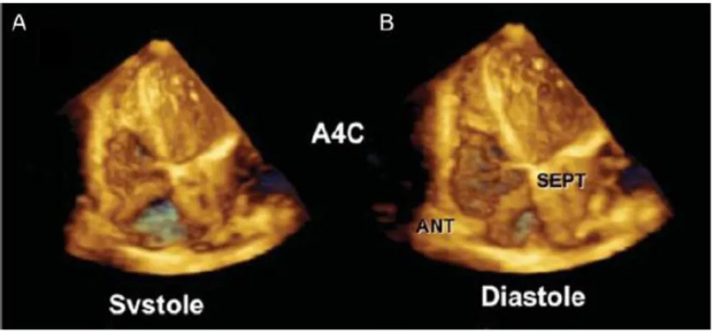 Figure 12 : image échographique 3D centrée sur le ventricule droit en systole (A) et diastole (B)