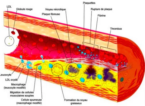 Figure 2 : Formation et Progression de l’athérosclérose 