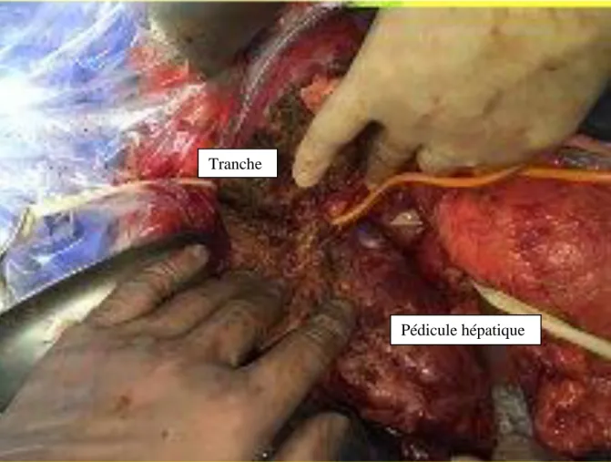 Figure 4. Tranche d'hépatectomie droite 