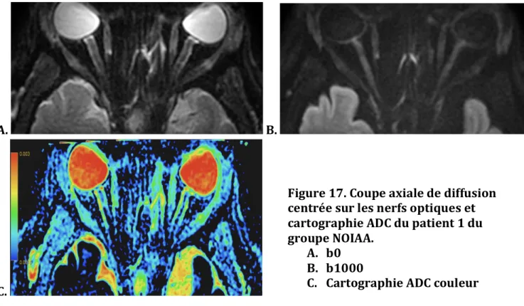 Figure 17. Coupe axiale de diffusion  centrée sur les nerfs optiques et  cartographie ADC du patient 1 du  groupe NOIAA