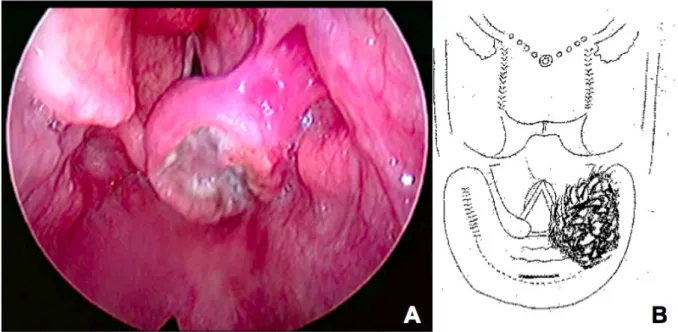 Figure 1 - Carcinome épidermoïde du sinus piriforme droit cT3 