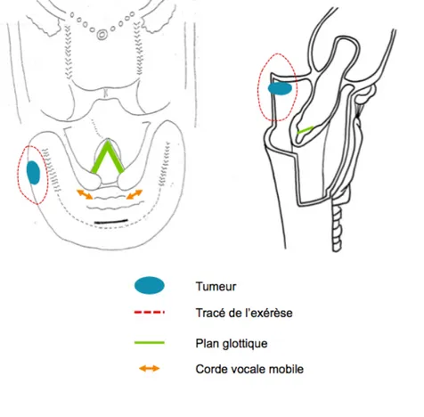 Figure  4  -  Schéma  d'exérèse  d'une  tumeur  de  la  paroi  latérale  du  sinus  piriforme  gauche  par  pharyngectomie latérale gauche 