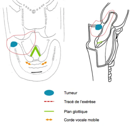 Figure 5 - Schéma d'exérèse d'une tumeur de l'angle antérieur du sinus piriforme gauche par  hémipharyngolaryngectomie supra-glottique 