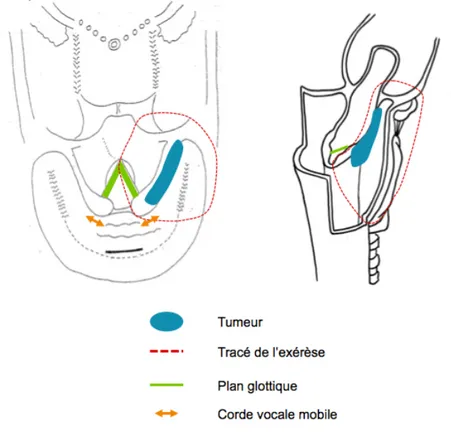 Figure  6  -  Schéma  d'exérèse  d'une  tumeur  de  la  paroi  médiale  du  sinus  piriforme  droit  par  hémipharyngolaryngectomie supra-cricoïdienne 