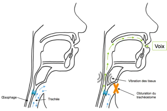 Figure 12 - Principe de la voix trachéo-oesophagienne 