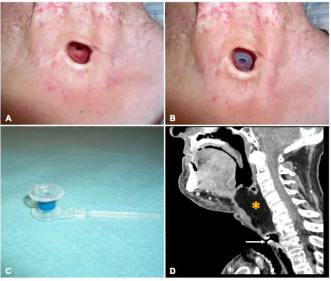 Figure 13 - Réhabilitation vocale par prothèse trachéo-oesophagienne 