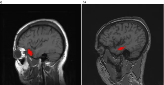 Figure 1. Post-surgery MRI of a patient with ATL resection (a) and of a patient with SeAH  resection (b)