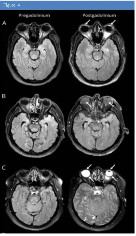 Figure  4. issue de l’article original d’Hitomi (62), montrant des images d’IRM  cérébrale  en  séquence  FLAIR  de  patients  atteints  d’AVC  ischémique  avant  (colonne de gauche) et après injection de chélate de gadolinium (colonne de  droite) montrant