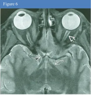 Figure  6.  Coupe  axiale  en  pondération  T2  (d’après  A.Osborn)  en  IRM  montrant  le  nerf  optique  (flèche  double), le chiasma optique (flèche simple) et le tractus  optique (flèche courbe)