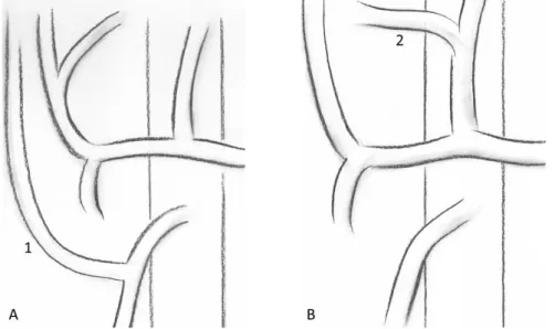 Figure 3. 2 variantes fréquentes de la vascularisation artérielle hépatique. A. Artère hépatique  droite (1)