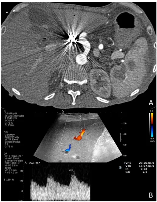 Figure  5.  Patient  transplanté  hépatique  ayant  nécessité  une  embolisation  de  son  artère  pour  pseudoanévrysme  dans  les  suites  d’une  angioplastie