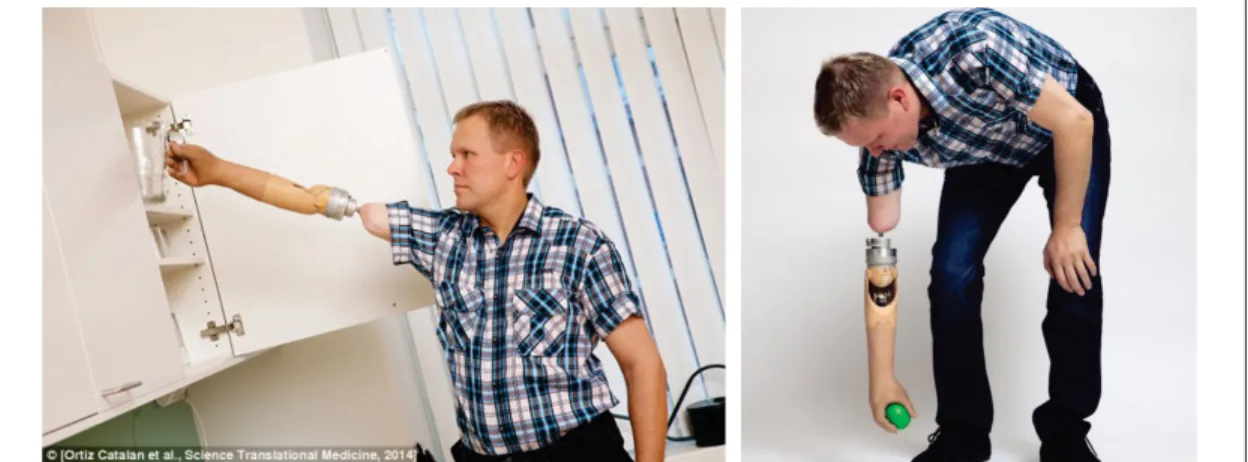 Figure 1.6 Prosthetic user is trying to accomplish manipulation task under continuous visual observation