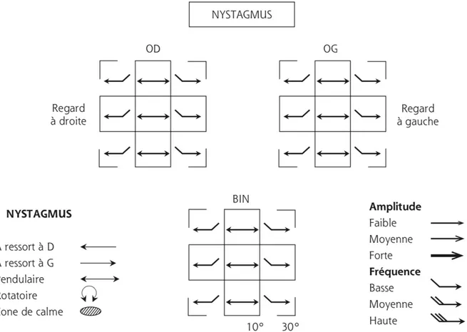 Figure 2 : Caractéristiques cliniques du nystagmus de l’INS (syndrome du nystagmus précoce) chez le  nourrisson (OD : œil droit fixateur, OG : œil gauche fixateur, BIN : en vision binoculaire).[19]  