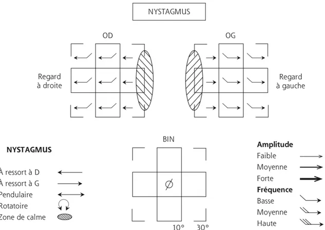 Figure 3 : Caractéristiques cliniques du nystagmus de type FMNS, dans sa forme latente pure (OD :  œil droit fixateur, OG : œil gauche fixateur, BIN : en vision binoculaire).[19] 