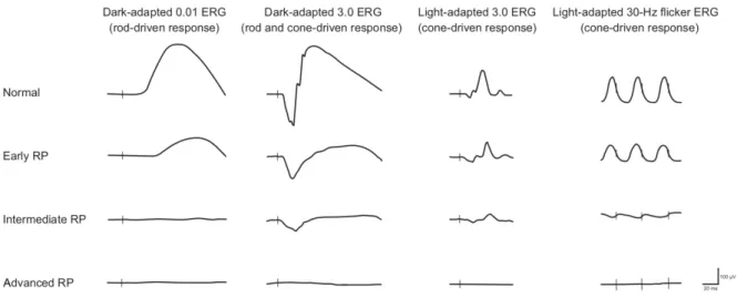 Figure  13 :  Aspect  schématique  simplifié  de  l’ERG  global  en  fonction  de  l’importance  de  l’atteinte  dans les dystrophies rétiniennes héréditaires de type bâtonnets-cônes