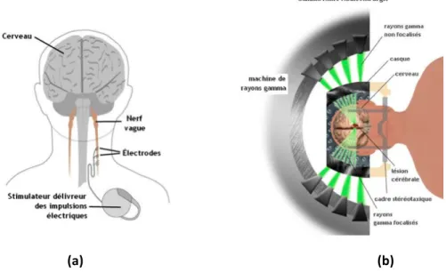 Figure   6   :   Autres   approches   possibles   du   traitement   de   l’épilepsie   ;   la   Stimulation   du   nerf   vague   (a),       le   Gamma   Knife   (b)      [45]