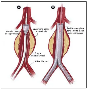 Figure 4 : Technique EVAR. A- Mise en place des  introducteurs et de l’endoprothèse. B- Déploiement de  l’endoprothèse dans la lumière aortique