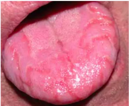 Figure  3  LG  de  type  I  :  les  lésions  sont  présentes  sur toute la face dorsale de la langue[1] 