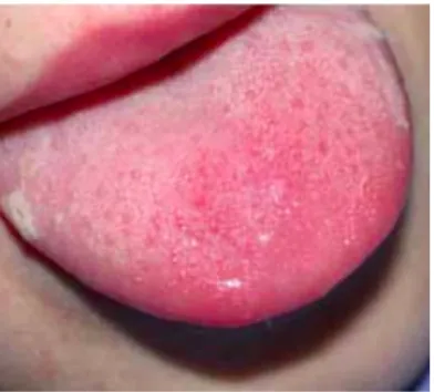 Figure  5:  LG  type  III  lésions  avortées  blanc-jaunâtres  bords latéral de langue[1] 