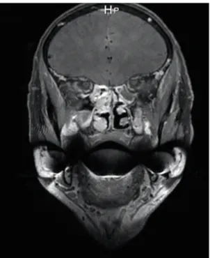 Figure 4 : IRM du massif facial en coupe coronale, séquence T1 injectée. Lésion ethmoïdale  droite rehaussée après injection de gadolinium correspondant à un mélanome