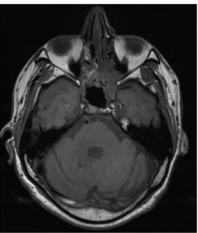 Figure 5 : IRM du massif facial en coupe axiale, séquence T1. Mélanome ethmoïdal  droit