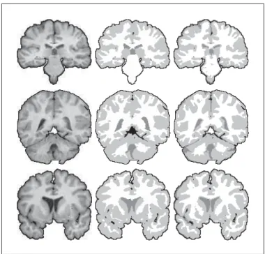Figure 3.7 Sample segmentation for the IBSR dataset (Worth, 1996). Left: input data.
