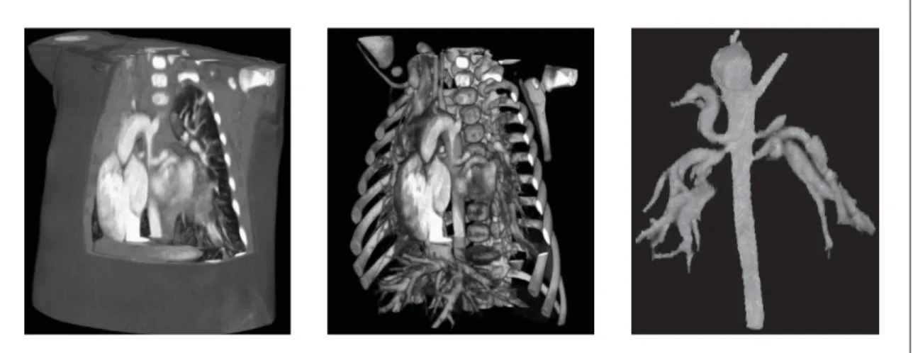 Figure 0.5 CTA scan of a young child with MAPCAs. Volume rendering (left), volume rendering with transparent soft tissues (middle), and 3D presentation of the segmented
