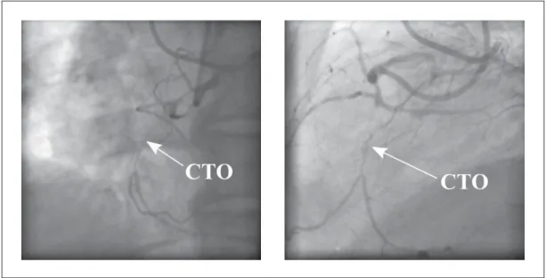Figure 0.7 Biplane ﬂuoroscopy of a left coronary artery with CTO 0.2 Problem statement