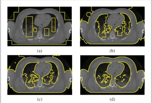 Figure 1.2 Evolution of the level-set during a segmentation. (a) initialization, (b) after 50 iterations; (b) after 100 iterations; (b) ﬁnal contour, after 300 iterations.