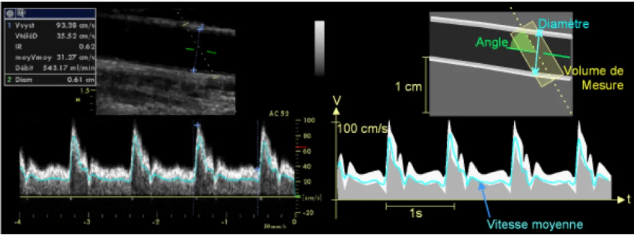 Figure 8: Enregistrement doppler d'une FAV 