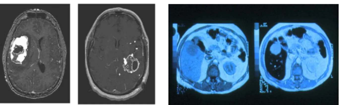 Fig. 4. MRI images before (right) and after (left) injection of a contrast agent, in a GBM-affected brain