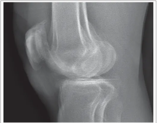 Figure 1.11 Exemple de genoux superposés sur une image radiographique EOS de proﬁl
