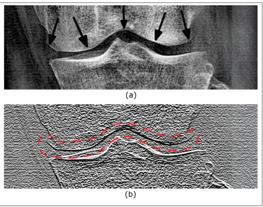 Figure 1.14 Mise en évidence du contour du fémur (a) Radiographie de face du genou. Les ﬂèches noires pointent l’unique contour du fémur
