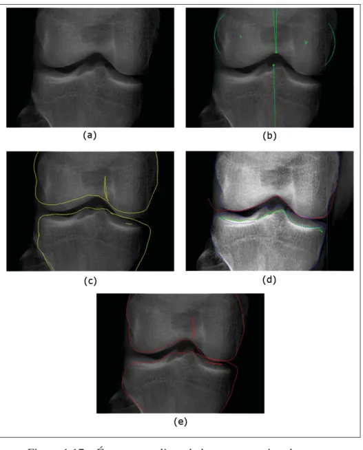 Figure 1.17 Étapes complètes de la reconstruction du genou dans SterEOS sur une image de face