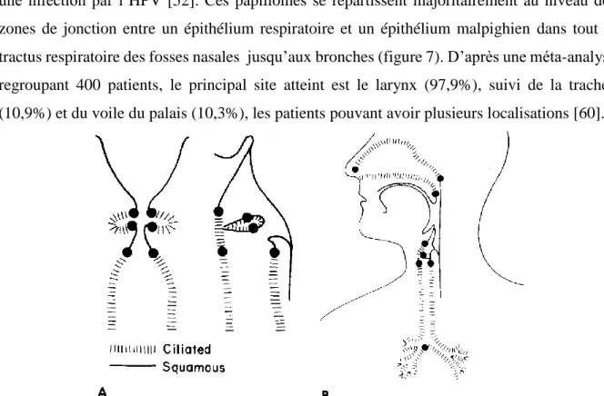 Figure 7 : Localisations des papillomes dans la PRR d'après Kashima [60]. A : Larynx B : Voies aériennes 