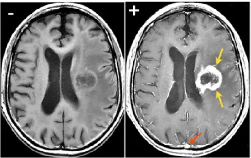 Figure 20 : Images d’IRM  d’une tumeur cérébrale dont la barrière hémato-encéphalique  est brisée  acquises  sans  agent de contraste (gauche)  et avec chélate de gadolinium  (droite)