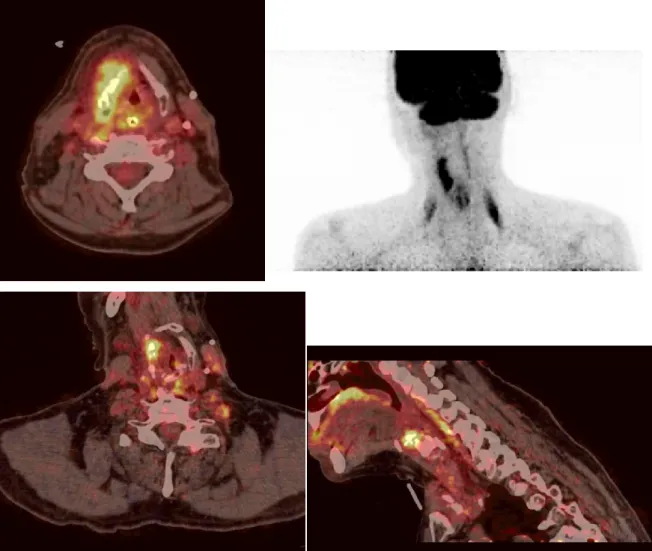 Figure 5 : Photographies des images de TEP-TDM de Monsieur G., pendant la surveillance de  son  cancer  des  VADS :  radionécrose  post-thérapeutique