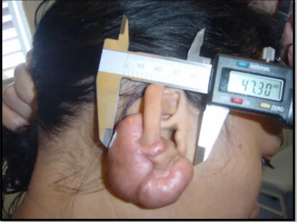 Figure 18 : Mesure d’une chéloïde avant chirurgie à l’aide d’un pied à coulisse digital 