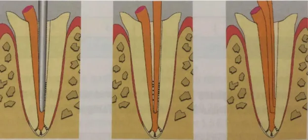 Figure 3 : Illustration de la compaction du maître cône puis rajoute des cônes accessoires 