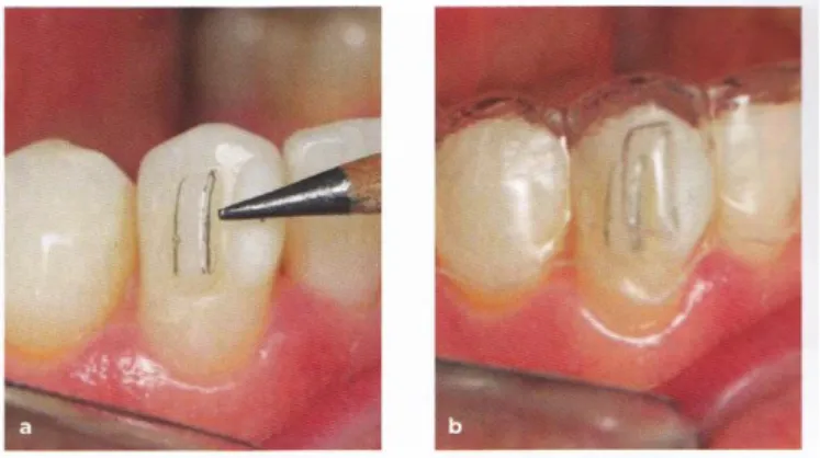 Figure 6 a et b : Marquer les taquets avec un crayon permet au clinicien de voir si l’aligneur s’insère  correctement 