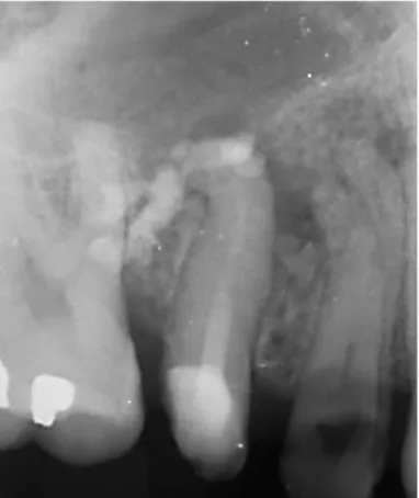 Figure 4 : Dépassement important de pâte d’hydroxyde de calcium dans le péri apex 