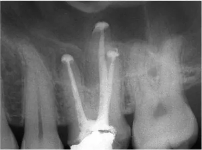 Figure 5 : Surobturation apicale sur une molaire maxillaire 