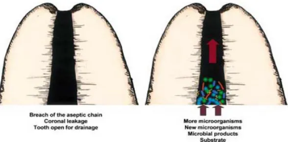 Figure 8 : L’introduction de nouvelles bactéries ou de substrat nutritif au cours des procédures  endodontiques peut provoquer une infection secondaire 