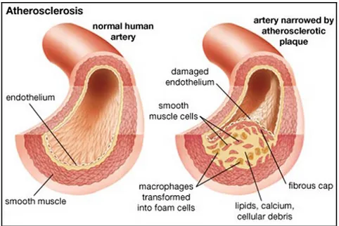 Figure 1.2. Schematic view of narrowing artery due to  atherosclerotic plaque. Taken from (Merck, 2014)