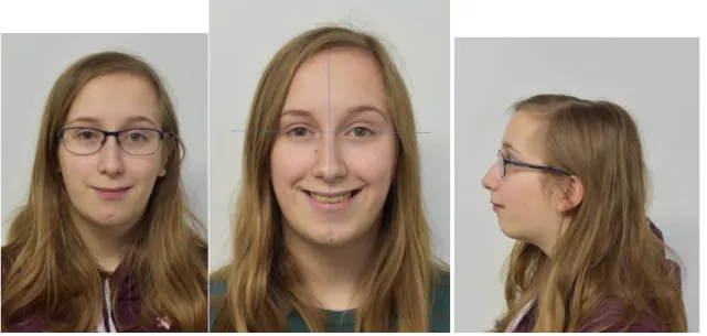 Figure 2 : Photos visage de face bouche fermée, sourire avec repère esthétique, visage de profil 